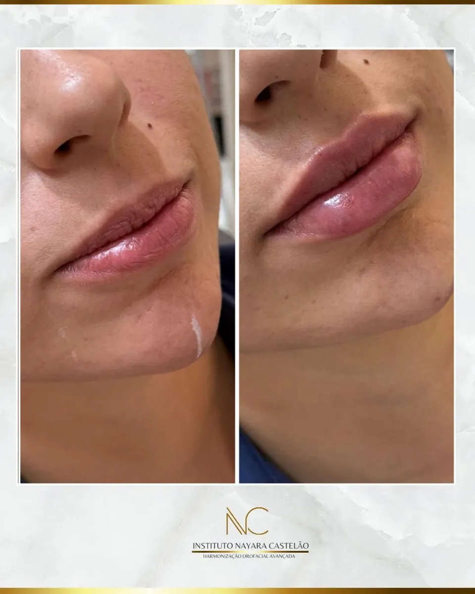 Antes e depois — preenchimento labial