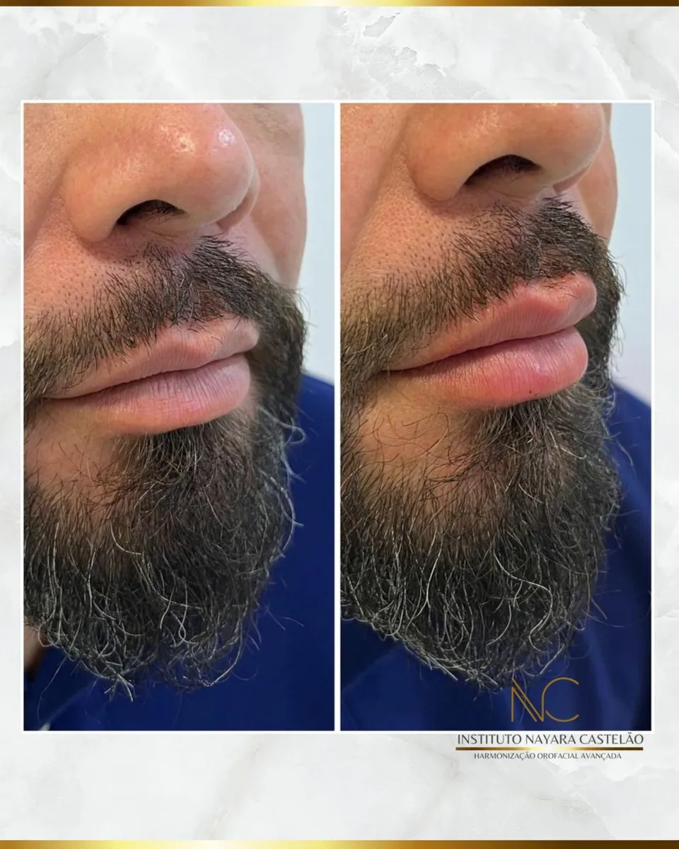Antes e depois — preenchimento labial masculino