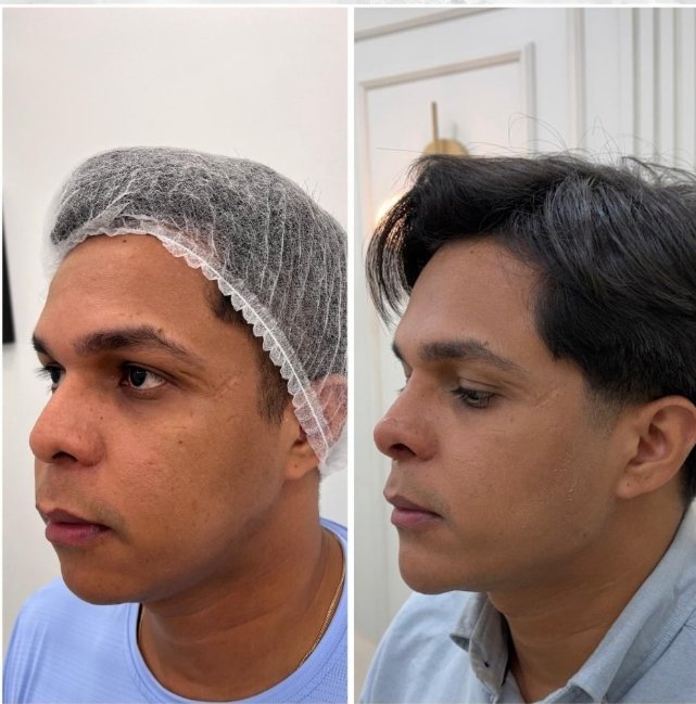 Antes e depois — harmonização facial masculina