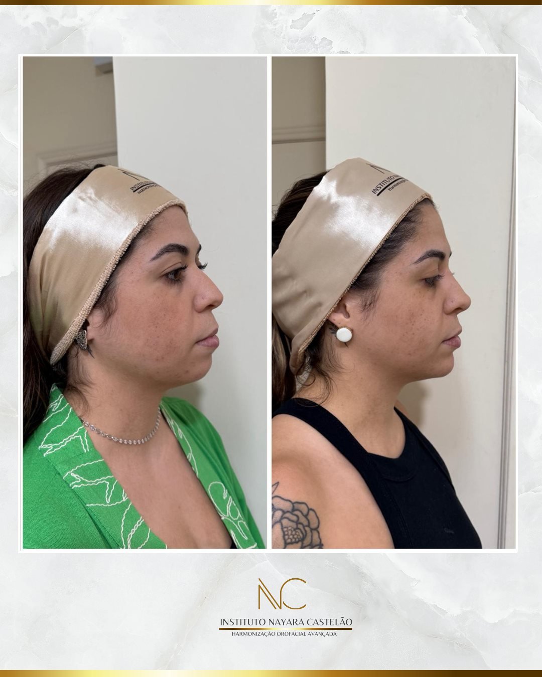 Antes e depois — perfiloplastia