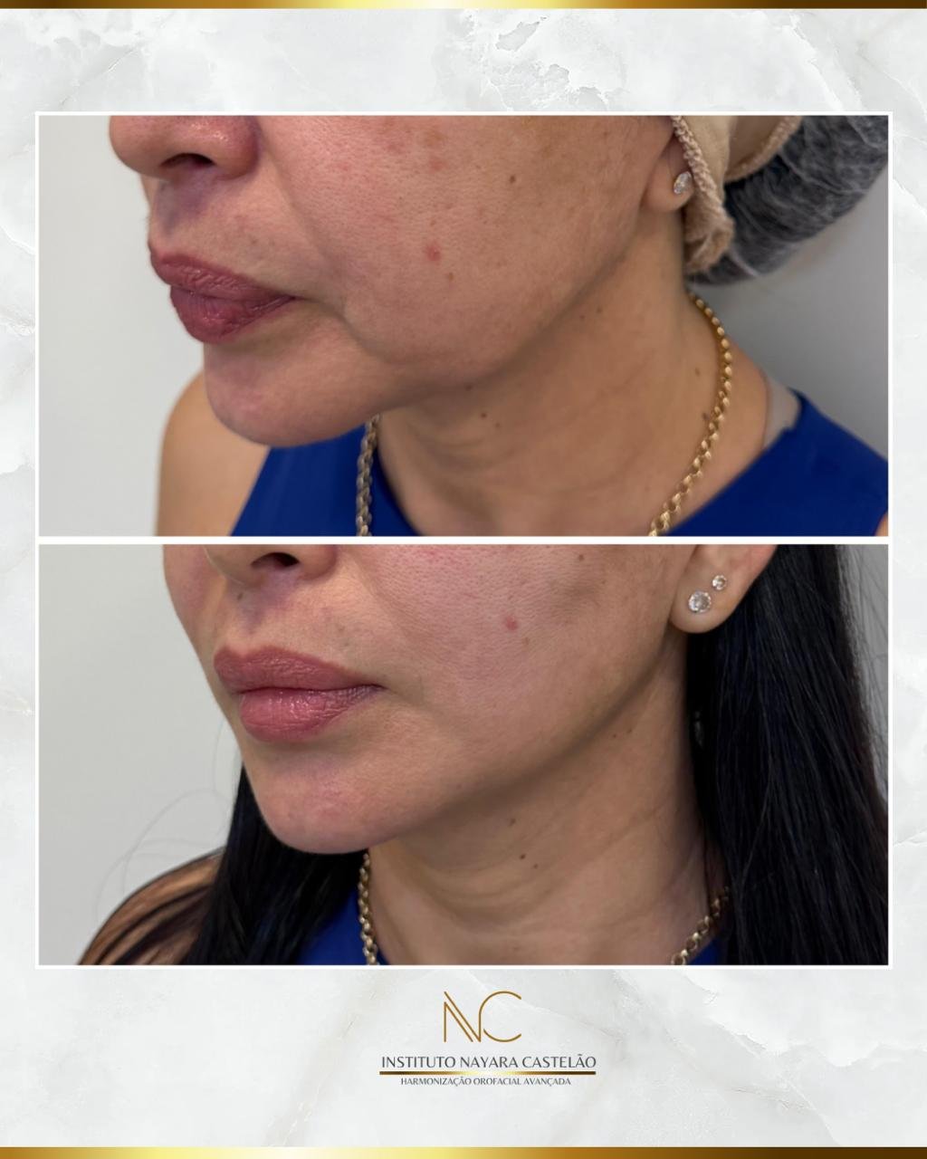 Antes e depois — fios de sustentação facial