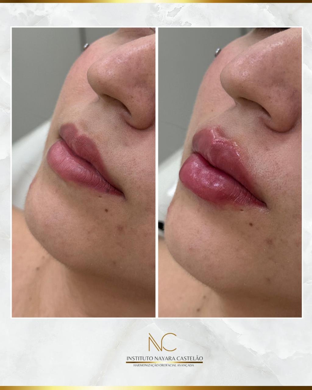 Antes e depois — preenchimento labial