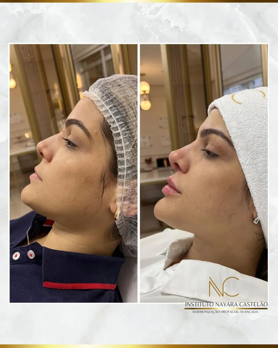 Antes e depois — perfiloplastia