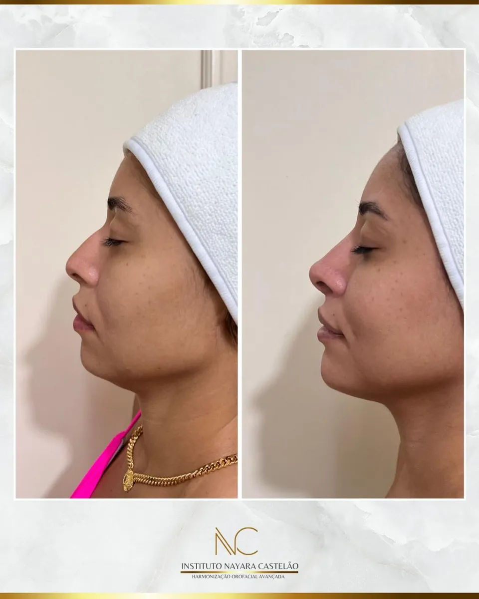 Antes e depois — perfiloplastia